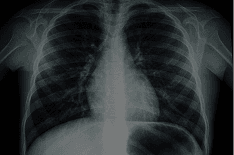 Tuberculosis